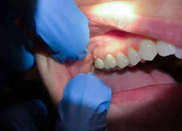 Best Emergency Dental Extractions in Carlisle, OH