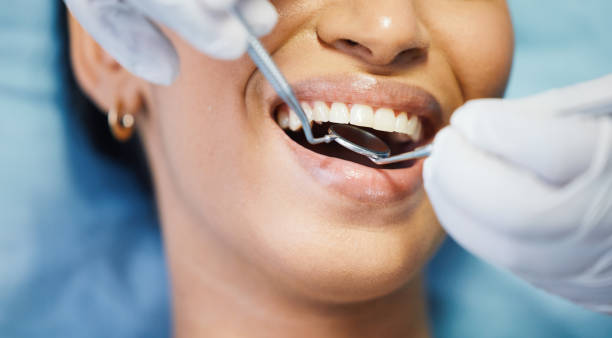Best Emergency Dentist for Lost Fillings or Crowns in Carlisle, OH